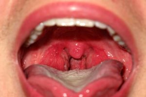 миндалины в полости рта