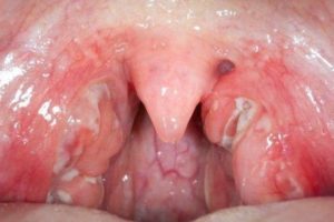 воспаление гортани в полости рта
